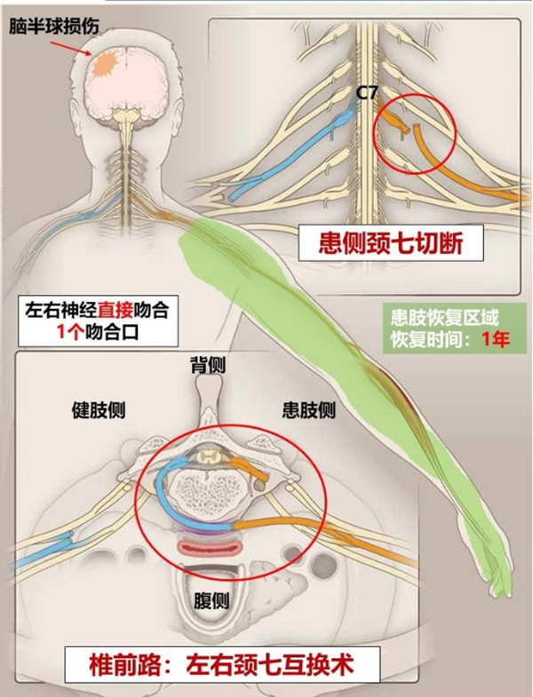 华山医院手外科徐文东教授领衔项目荣获2019年度中华医学科技奖一等奖插图_副本.jpg