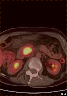 胰腺癌