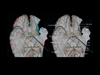 脑白质纤维束与深部核团的显微解剖学研究-脑精细图谱构建及精准入路应用